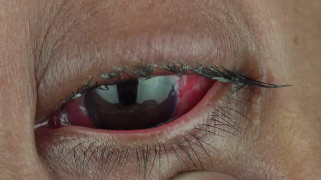 The eyes of women after pterygium surgery.
