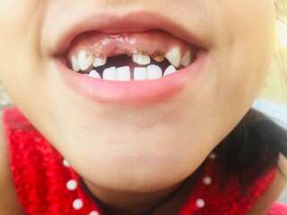 Dental problem and tooth disease.
