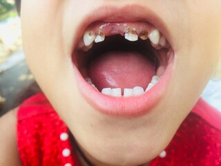 A little girl with open mouth showing her cavity infection and toothache teeth for checkup. Decayed...