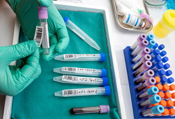 Scientific sticker on blood sample vial with four samples of cerebrospinal fluid in patients with...