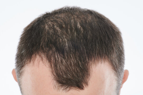 Man losing hair on head
