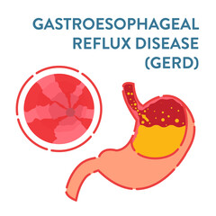 Gastroesophageal reflux disease diagnostics poster. Endoscopic image of stomach with GERD. Esophagus after acid reflux. Health care and medical concept. Vector illustration. 