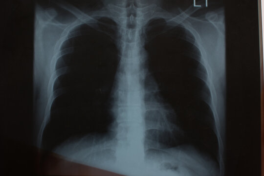 X-ray film Used in medicine