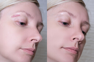 Hypertrophic keloid scar on woman face before and after laser treatment, removal, heal and recovery...