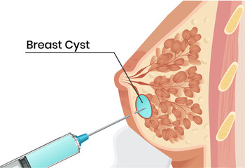 Breast cyst aspiration under the ultrasound guidence