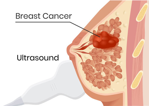 Breast cancer ultrasound. Vector illustration of the breast carcinoma screening