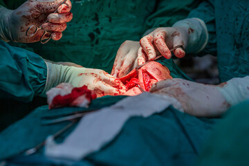 Doctors operating neck tumor in hospital