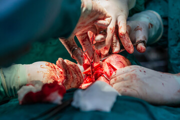 Doctors operating neck tumor in hospital