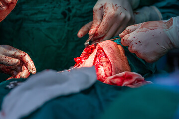 Doctors operating neck tumor in hospital