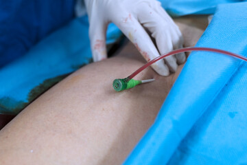 Scrub nurse press at puncture site of patient’s groin. Focus at introducer sheath.