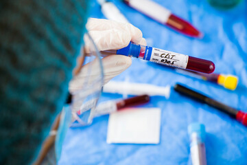 CBC blood test tube sample in doctors hand
