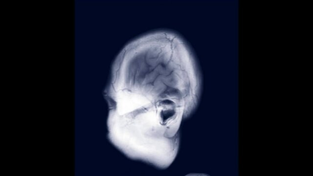 MRI of the brain in sagittal T1 showing anatomy of the brain.