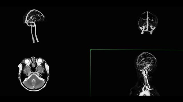 Comapre MRV Brain or magnetic resonance venography of The Brain Axial and mip view for abnormalities in venous drainage of the brain.