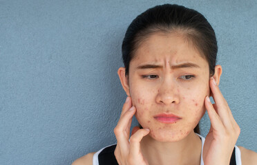 Portrait of worrying woman with problems of acne inflammation (Papule and Pustule) on her face....