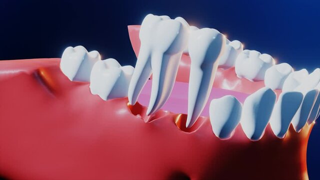 Tooth medical dental implant process. 3D render animation of ceramic implantation process at dentist in stomatology treatment of human smile orthdontic denture health. Oral health and medicine