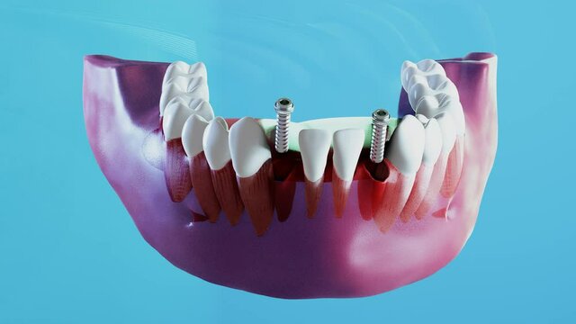 Ceramic dental implantation process. 3D render animation of stomatology dentist treatment, crown implant. Teeth treatment orthodontic surgery denture health and medicine. Oral hygiene