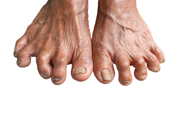 Closeup Foot Seniors. dirty feet on mortar. toenail fungus. Fungus Infection on Nails of Man's...