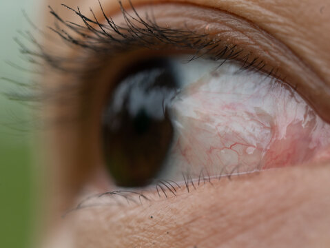 the women have a  Pinguecula in her eye