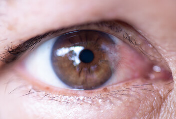 The eyes of people with cataract, a disease of the eye. - obrazy, fototapety, plakaty