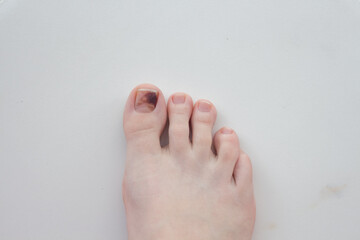  Toenails damaged by hematoma. Detachment of the nail, blow to the nail. Ingrown nail. Nail care concept
