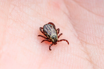 Lyme Disease Infected Tick Mite Insect Crawling on Skin. Encephalitis Virus or Lyme Borreliosis Infectious Dermacentor Tick Arachnid Parasite Close-up