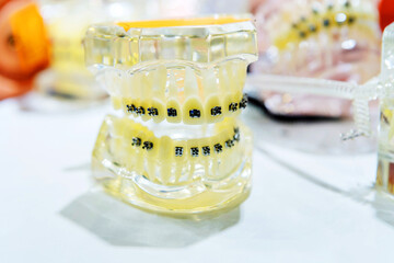 Tooth fixes. Plastic jaw with teeth on a light background. Demonstration model of the oral cavity...