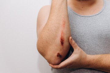 Large abrasions on the forearm of a man after a fall. The man holds his elbow with his hand.