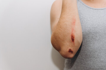 Large abrasions on the forearm of a man after a fall.