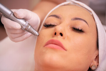 Close up of facial treatment with acupuncture pen