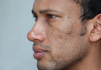 Fototapeta premium Close up of problematic skin with deep acne scars on cheek of a man