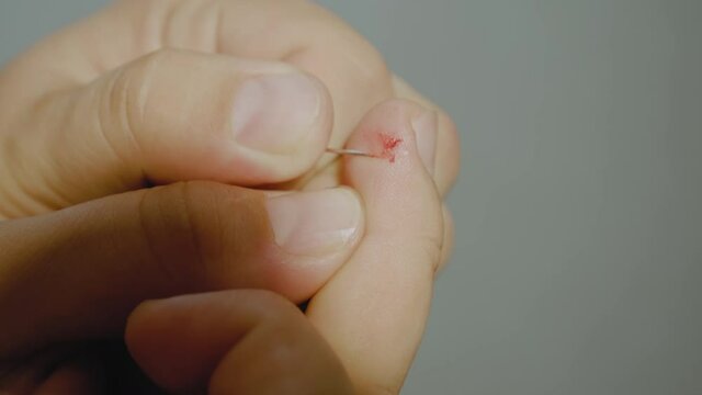 Method for self-removal of warts. Wart Removale Procedure using a needle.