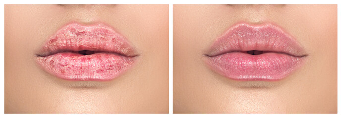 Lips. Close up of chapped, cracked lips, dry skin problem with mouth disease before and after...
