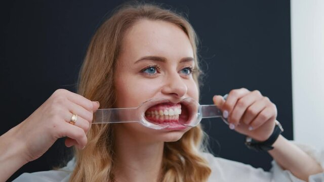 Healthy-looking woman female customer posing for photoshoot camera holding dental retractor showing white healthy teeth and cavities. Portraits. Stomatology. Dentistry.