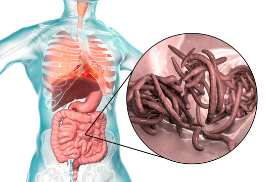 Parasitic worms in human small intestine