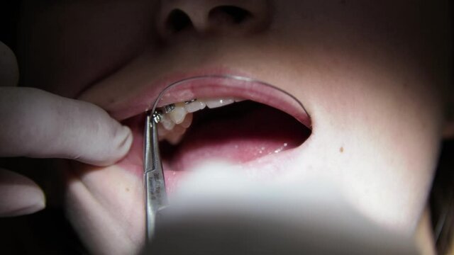 Young woman dentist. Replacement of elastic bands on braces. Mouth close-up.