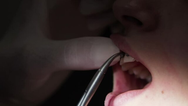 Young woman dentist. Replacement of elastic bands on braces. Mouth close-up.