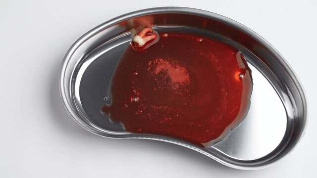 Footage of a bloodied wisdom tooth in a kidney-shaped tray