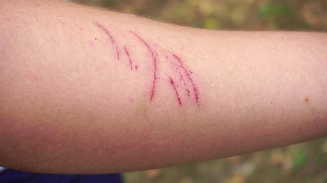 Red scratches on the skin of a man's hand, close-up, skin damage