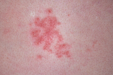 Fototapeta premium Human skin with red allergic spots, sores