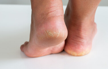 Dry heel rough crack skin on woman foot.