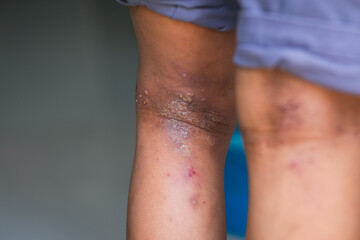 Close up on eczema, skin rash, atopic dermatitis on a boy's legs.