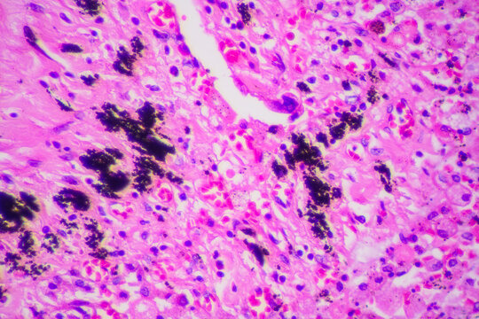 Viral pneumonia disease human cells