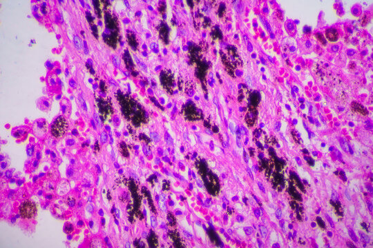 Viral pneumonia disease human cells
