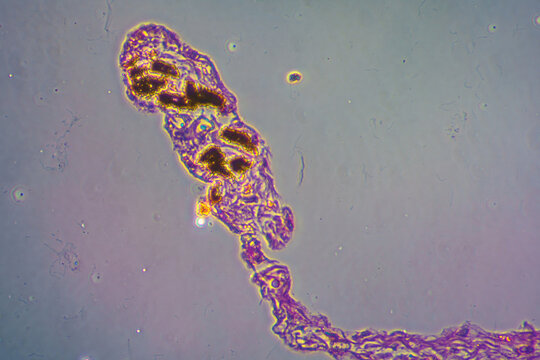 Viral pneumonia disease human cells
