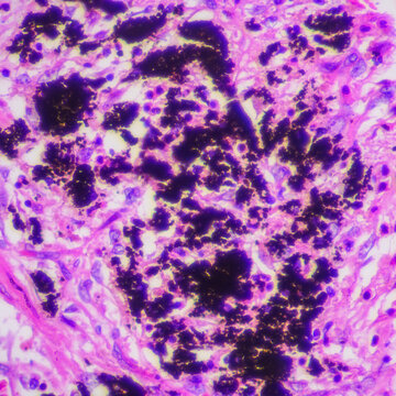 Viral pneumonia disease human cells