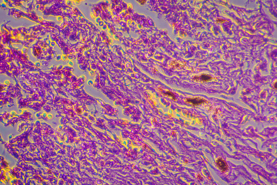 Viral pneumonia disease human cells