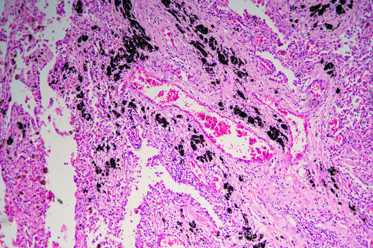 Viral pneumonia disease human cells