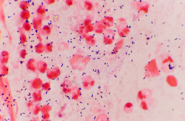Bacteria Gram positive in sputum gram stain.