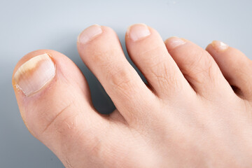onychomycosis, The initial stage of mycosis. Big toe infected with fungal bacteria