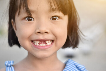 Cute little girl smile with her broken tooth. Close up of child front tooth broken.